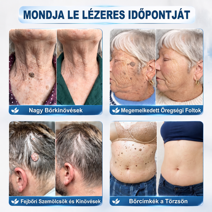 Hivatalos Márkabolt | 🚢 Mrevbsin® 7 napos Szemölcseltávolító Roll-on Ápoló Folyadék (Fájdalommentes rollerball technológia, hegek nélkül) 🐬