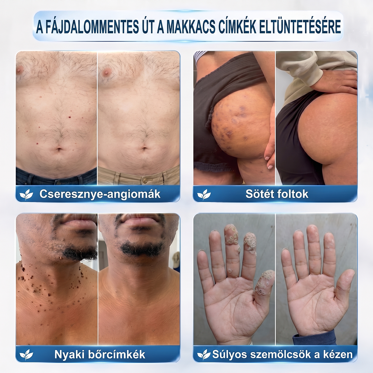 Hivatalos Márkabolt | 🚢 Mrevbsin® 7 napos Szemölcseltávolító Roll-on Ápoló Folyadék (Fájdalommentes rollerball technológia, hegek nélkül) 🐬