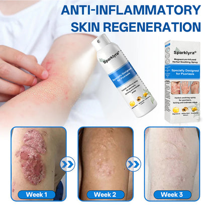 💥💥Official shop✅: Sparklyra® Herbal magnesium spray for psoriasis