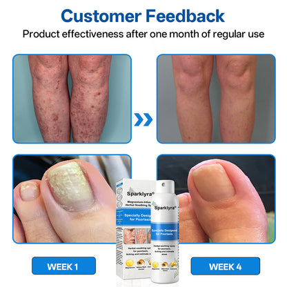 💥💥Official shop✅: Sparklyra® Herbal magnesium spray for psoriasis