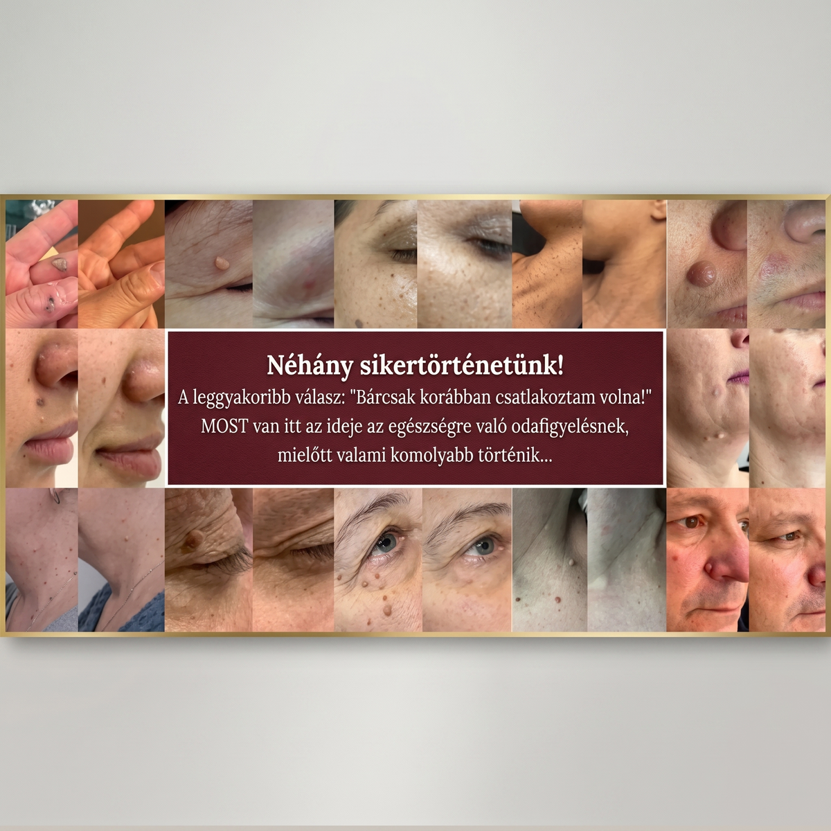🚚  Mrevbsin® 2 az 1-ben mikrotűs és hidrokolloid tapasz🧑‍⚕️ | Kiálló anyajegyek, aknék, lapos szemölcsök és bőrnövedékek eltávolítására | Segít csökkenteni a ráncokat, hegeket és bőrhibákat