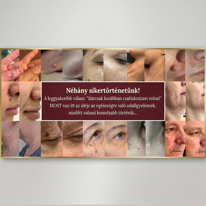 🚚  Mrevbsin® 2 az 1-ben mikrotűs és hidrokolloid tapasz🧑‍⚕️ | Kiálló anyajegyek, aknék, lapos szemölcsök és bőrnövedékek eltávolítására | Segít csökkenteni a ráncokat, hegeket és bőrhibákat