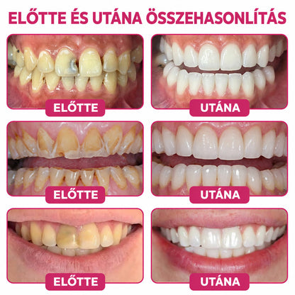 ⭐👨‍⚕️🦷Mrevbsin® DenPerm – Természetes fogzománc-töltő gél a fogszuvasodás helyreállítására🐟2️⃣
