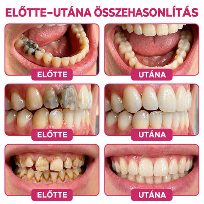 ⭐👨‍⚕️🦷Mrevbsin® DenPerm – Természetes fogzománc-töltő gél a fogszuvasodás helyreállítására🐟2️⃣