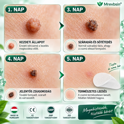 🚚  Mrevbsin® 2 az 1-ben mikrotűs és hidrokolloid tapasz🧑‍⚕️ | Kiálló anyajegyek, aknék, lapos szemölcsök és bőrnövedékek eltávolítására | Segít csökkenteni a ráncokat, hegeket és bőrhibákat
