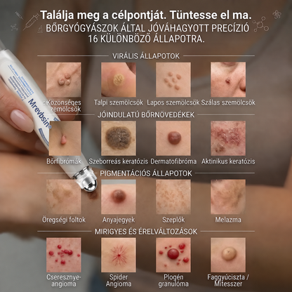 Hivatalos Márkabolt | 🚢 Mrevbsin® 7 napos Szemölcseltávolító Roll-on Ápoló Folyadék (Fájdalommentes rollerball technológia, hegek nélkül) 🐬