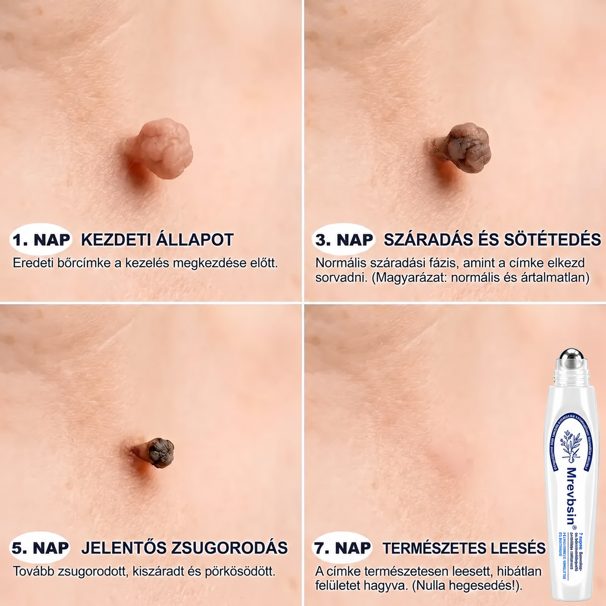 Hivatalos Márkabolt | 🚢 Mrevbsin® 7 napos Szemölcseltávolító Roll-on Ápoló Folyadék (Fájdalommentes rollerball technológia, hegek nélkül) 🐬