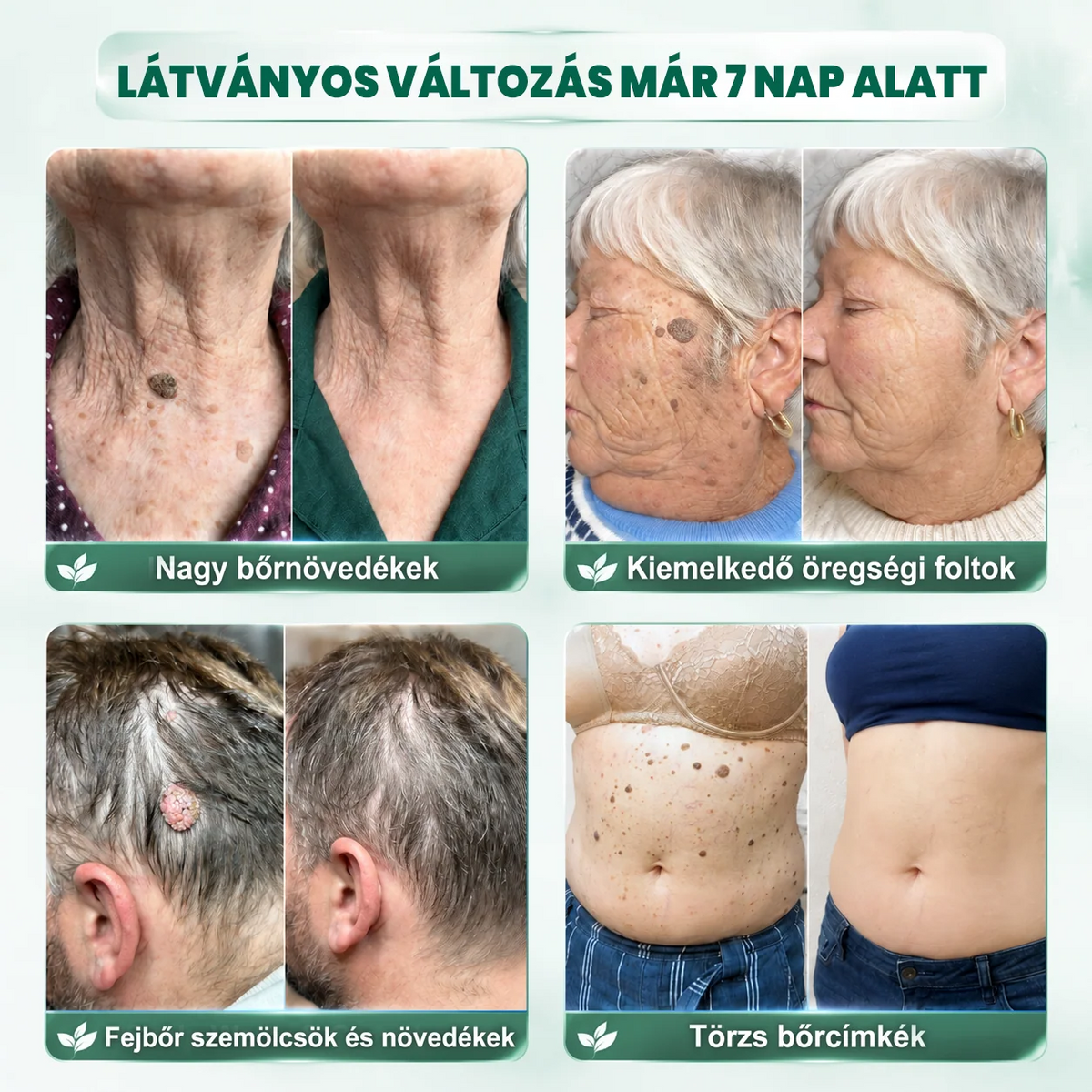 🚚  Mrevbsin® 2 az 1-ben mikrotűs és hidrokolloid tapasz🧑‍⚕️ | Kiálló anyajegyek, aknék, lapos szemölcsök és bőrnövedékek eltávolítására | Segít csökkenteni a ráncokat, hegeket és bőrhibákat