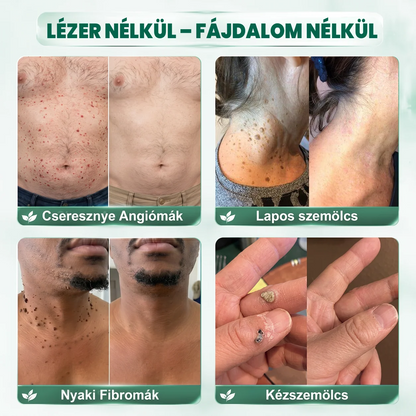 🚚  Mrevbsin® 2 az 1-ben mikrotűs és hidrokolloid tapasz🧑‍⚕️ | Kiálló anyajegyek, aknék, lapos szemölcsök és bőrnövedékek eltávolítására | Segít csökkenteni a ráncokat, hegeket és bőrhibákat